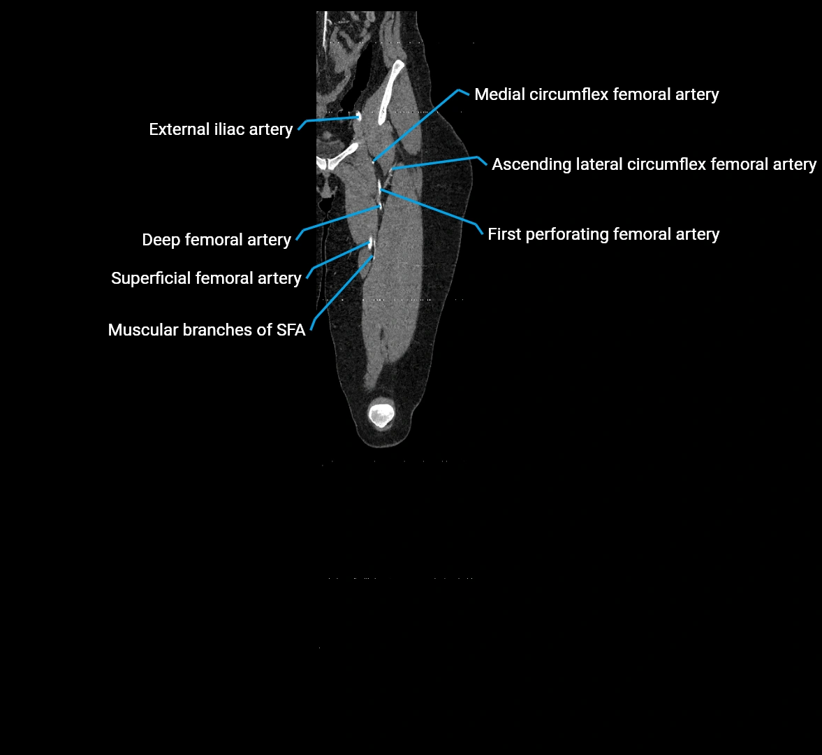 CTA lower limb coronal cross sectional anatomy labelled image _21 (2).webp